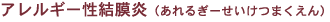 アレルギー性結膜炎(あれるぎーせいけつまくえん)