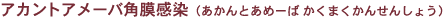 アカントアメーバ角膜感染症(あかんとあめーば かくまくかんせんしょう)